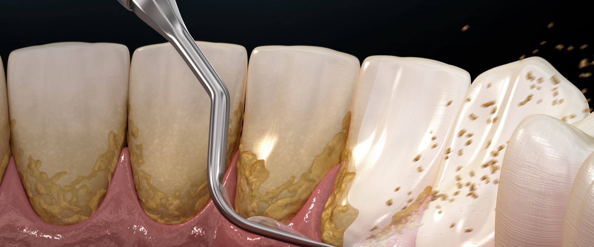 What are the Most Common Periodontal Procedures?