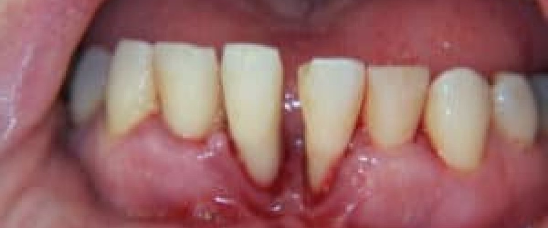 Can You Fix Severe Periodontal Disease?