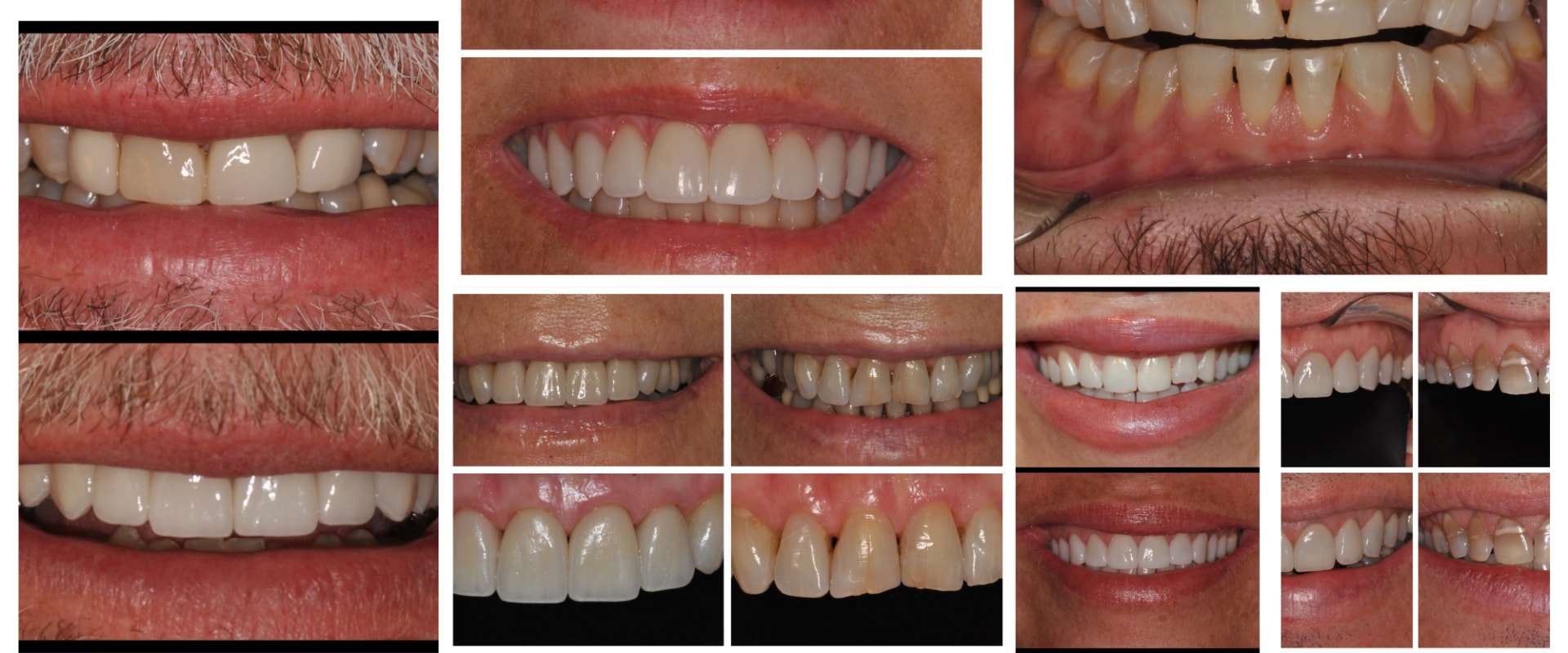 What are Dental Veneers and How Can They Improve Your Smile?