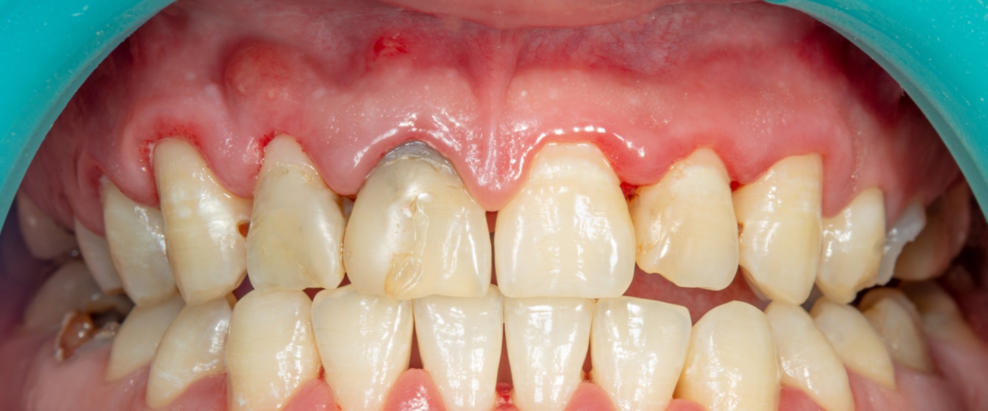 What is a Periodontal Pocket and How to Treat It