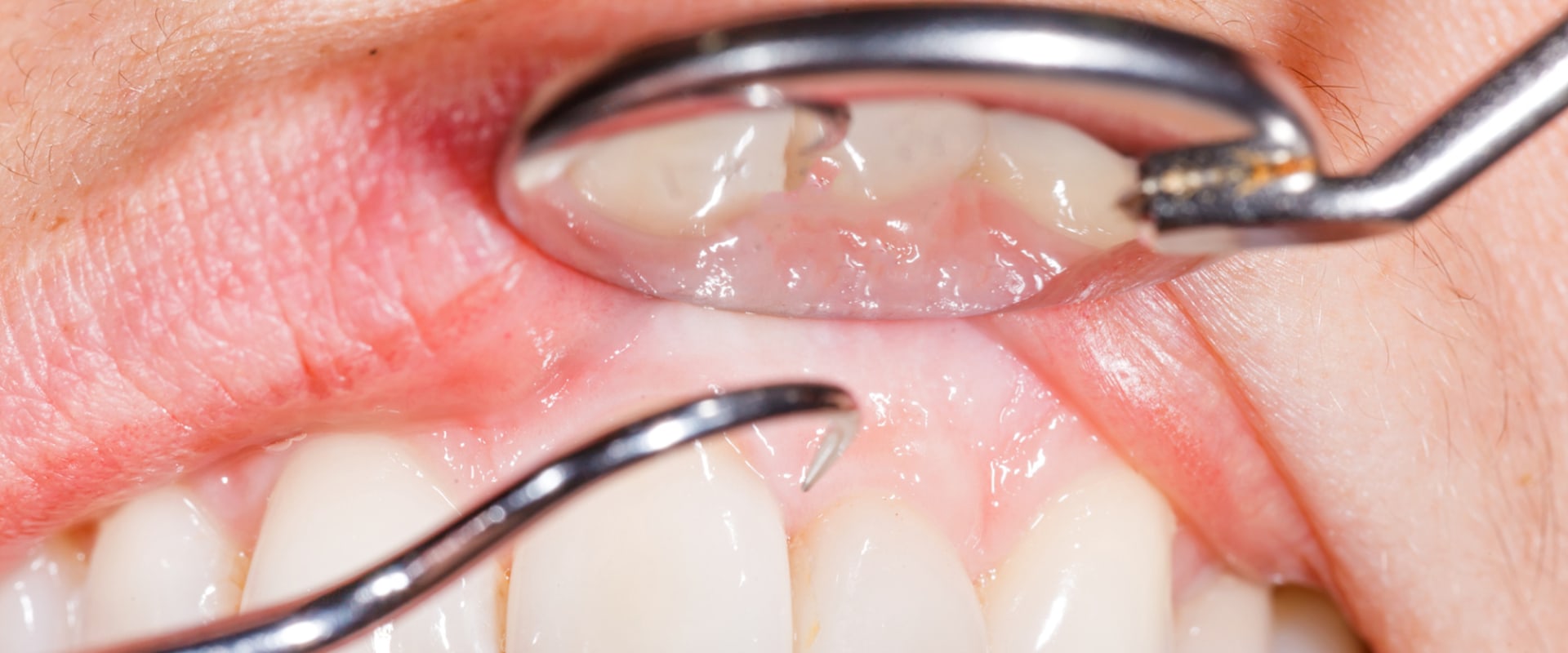 San Antonio, TX Periodontics: How To Prevent Gum Disease Effectively