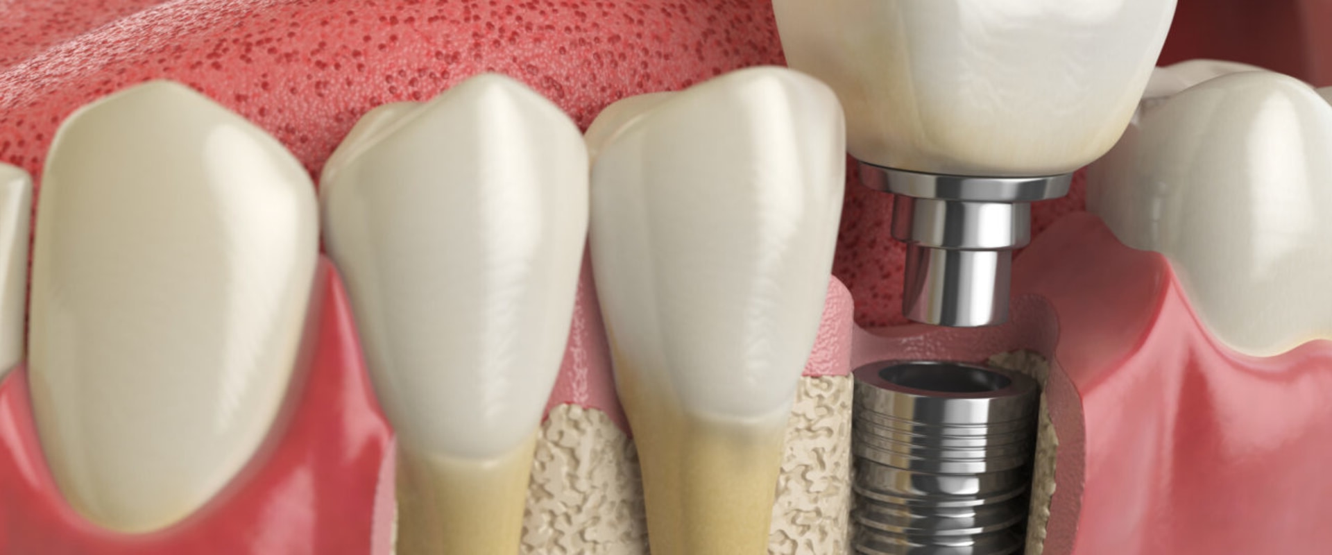 The Road To A New Smile: Periodontics Leading To Dental Implants In Cedar Park, TX
