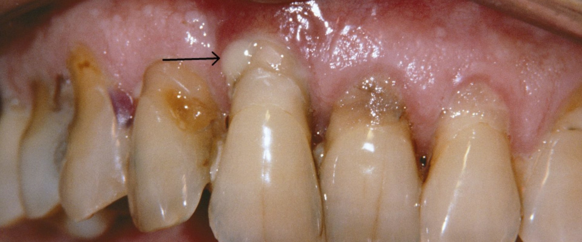 What are the Symptoms of Periodontitis and How Can You Prevent It?