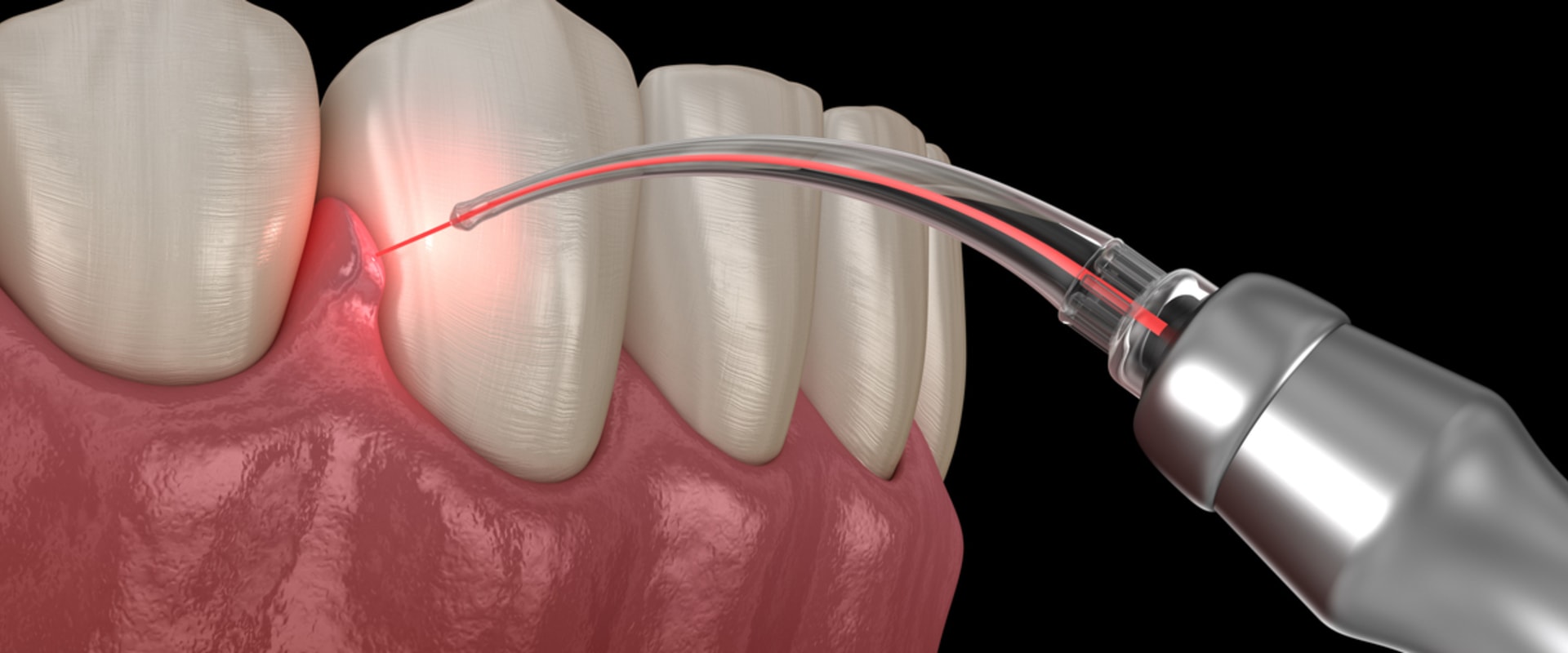 What Surgery is Needed for Periodontal Disease?