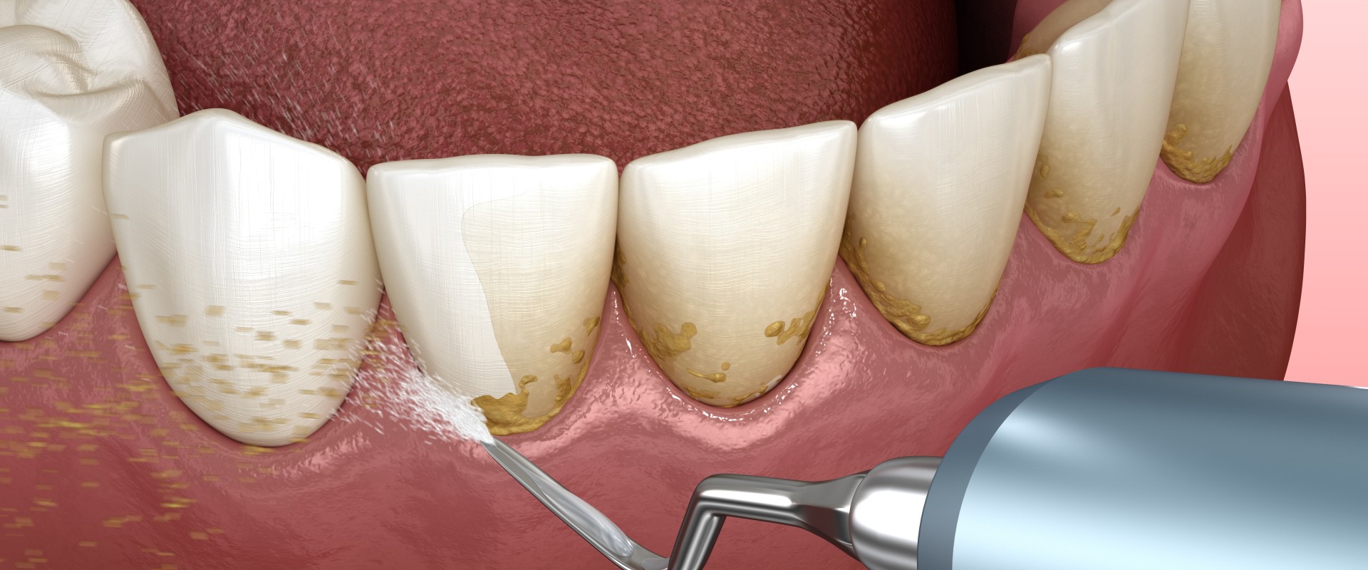 Treating Periodontal Disease: A Comprehensive Guide
