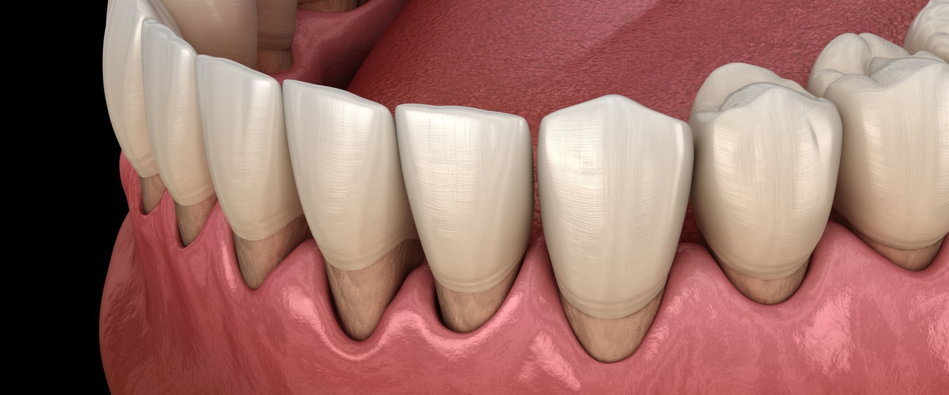 What is a Gum Graft? A Comprehensive Guide