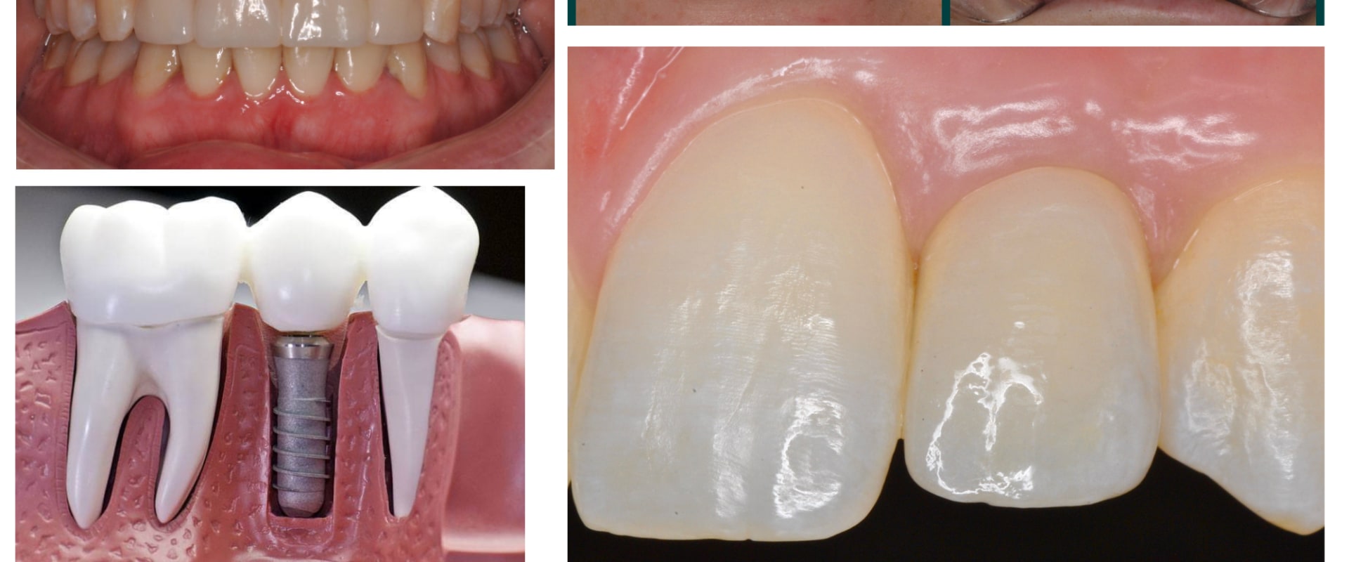 Smile Confidently With Dentures In Austin: How Periodontics Makes A Difference