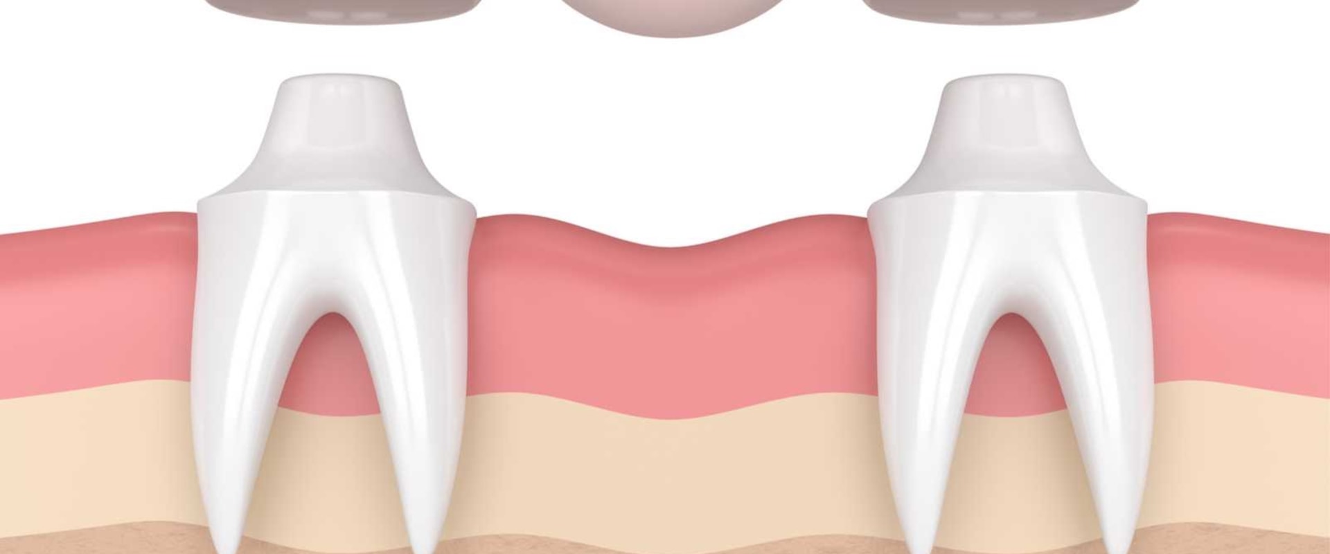 What is a Dental Bridge and How Can it Help You?