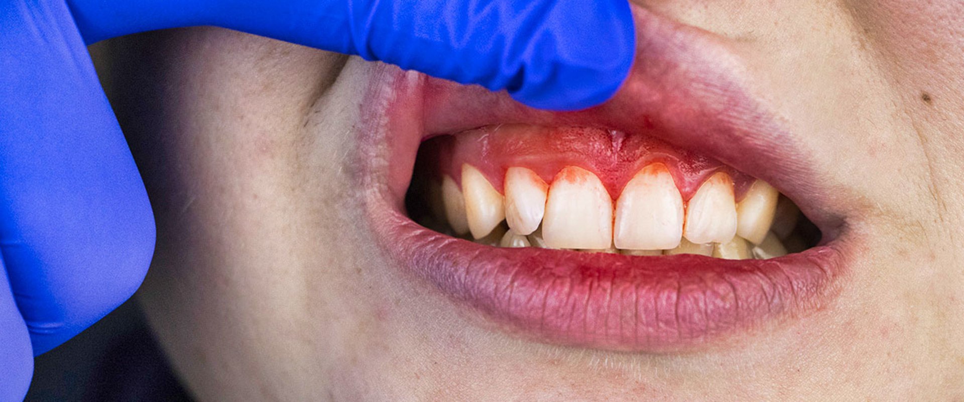 What are the Symptoms of Periodontal Disease?