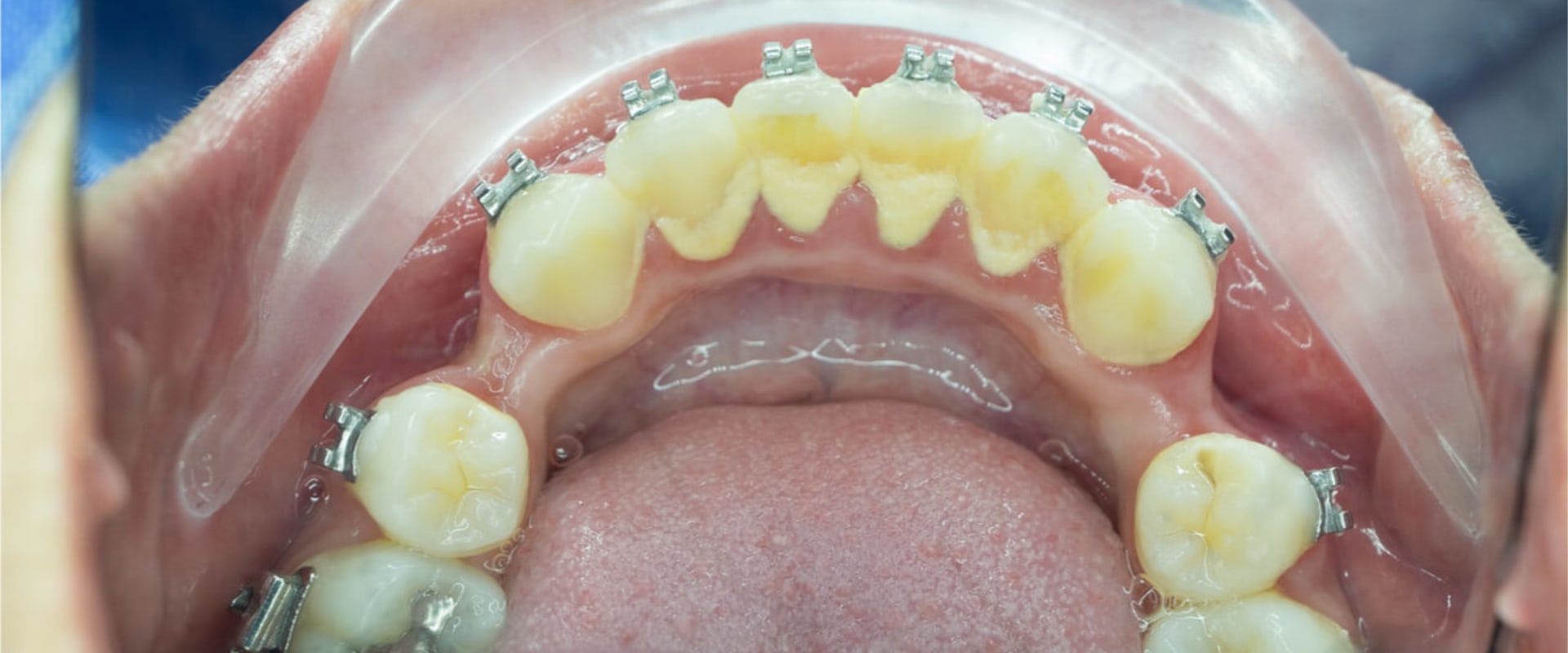 Can I Get Braces If I Have Periodontal Disease?