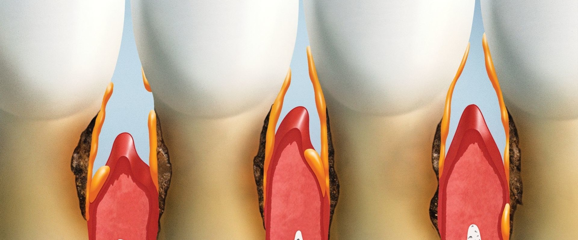 How to Fix Gum Pockets: A Guide for Dentists