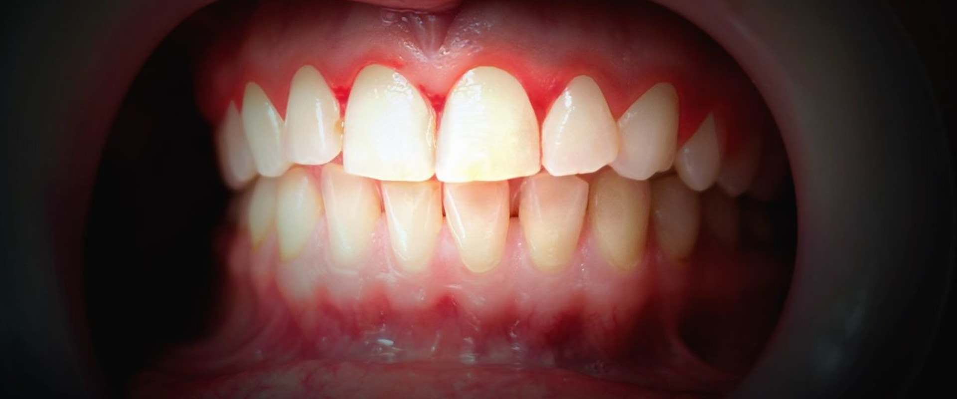 The Impact of Stress on Periodontal Health