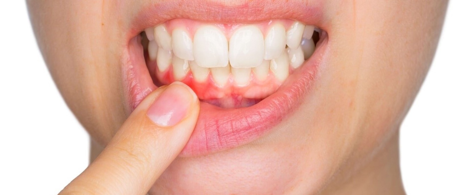 What is Periodontitis and How Can it be Treated?