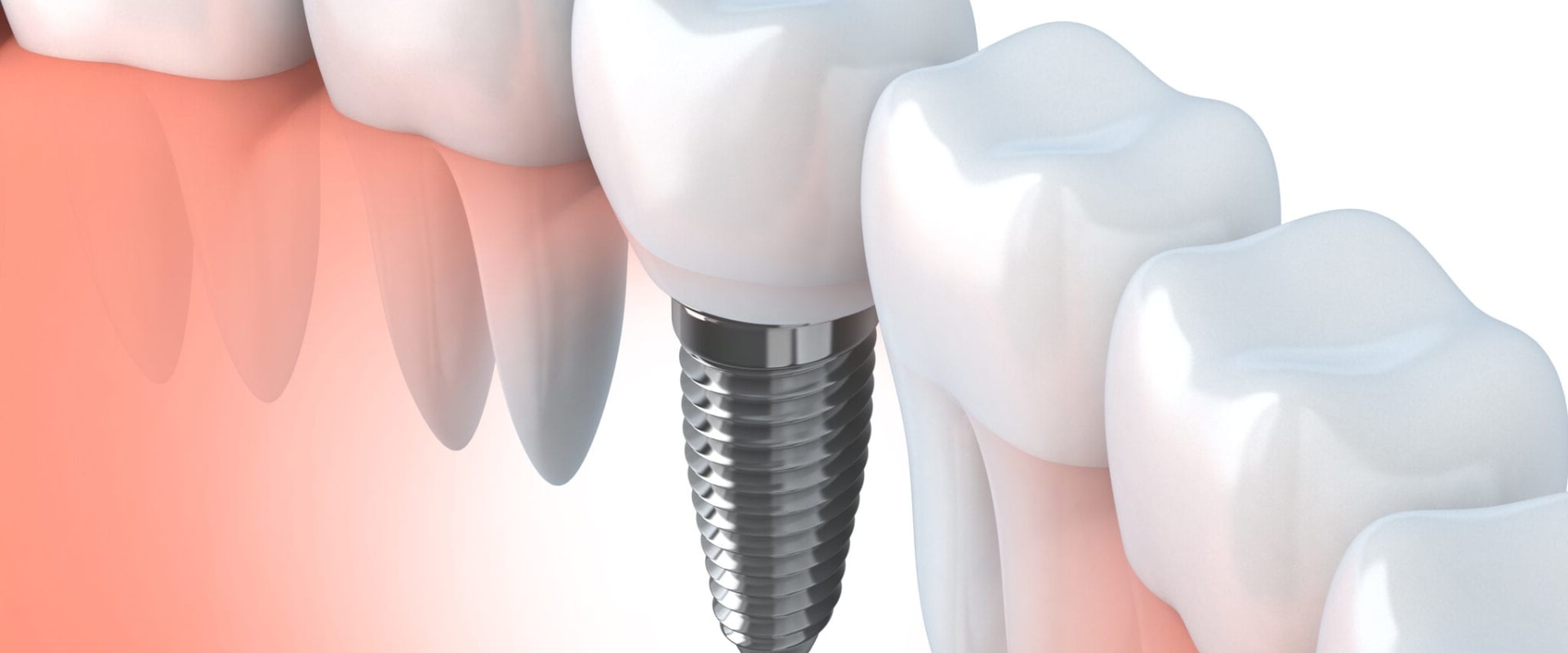 Can Dental Implants And Periodontics Help Improve Overall Oral Health During Full Teeth Replacement In Bexley?