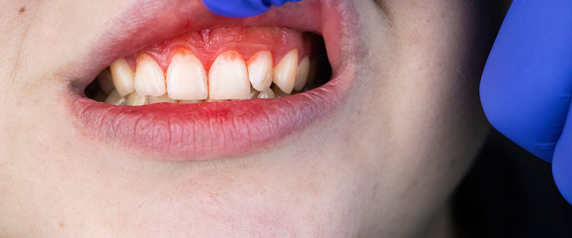 Types of Periodontal Diseases: What You Need to Know
