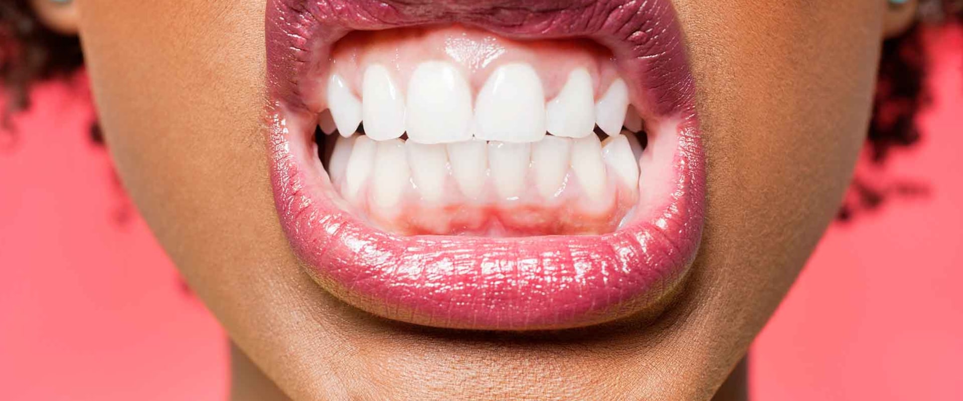 Gingivitis: What You Need to Know