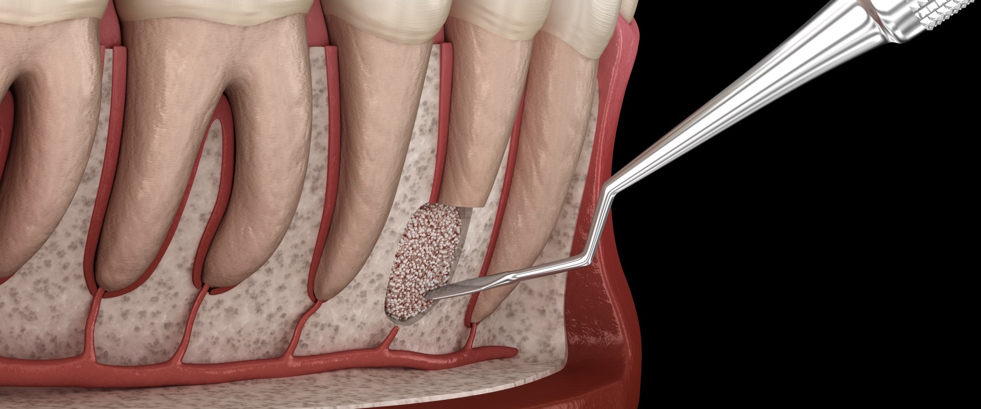 What is the Most Common Periodontal Surgery?