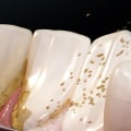 What Does Periodontal Disease Feel Like?