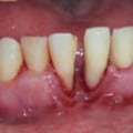 Can You Fix Severe Periodontal Disease?