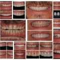 What are Dental Veneers and How Can They Improve Your Smile?