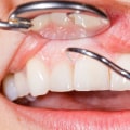 San Antonio, TX Periodontics: How To Prevent Gum Disease Effectively