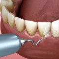 Treating Periodontal Disease: A Comprehensive Guide