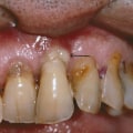What are the Symptoms of Periodontitis and How Can You Prevent It?