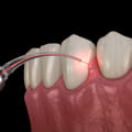 What Surgery is Needed for Periodontal Disease?