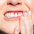 Lifestyle Changes to Combat Periodontal Disease