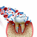 The Hidden Connection Between Inflammation and Periodontal Disease