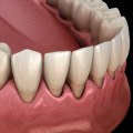 What is a Gum Graft? A Comprehensive Guide