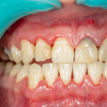 What are the Symptoms of Stage 2 Periodontitis?