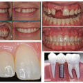 Smile Confidently With Dentures In Austin: How Periodontics Makes A Difference