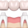 What is a Dental Bridge and How Can it Help You?