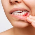 Basel Periodontics: How Dental Care Services Address Gum Disease