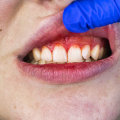 What are the Symptoms of Periodontal Disease?