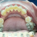 Can I Get Braces If I Have Periodontal Disease?