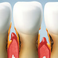 How to Fix Gum Pockets: A Guide for Dentists