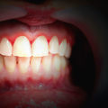 The Impact of Stress on Periodontal Health