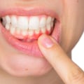 What is Periodontitis and How Can it be Treated?