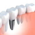 Can Dental Implants And Periodontics Help Improve Overall Oral Health During Full Teeth Replacement In Bexley?