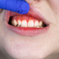 Types of Periodontal Diseases: What You Need to Know