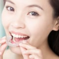 Your Journey To A Healthy Smile: The Best Invisalign In Austin After Periodontal Treatment