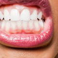 Gingivitis: What You Need to Know