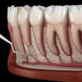 What is the Most Common Periodontal Surgery?