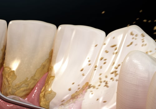 What Does Periodontal Disease Feel Like?