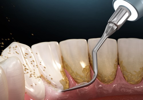 What are the Most Common Periodontal Procedures?
