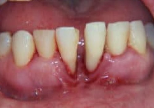 Can You Fix Severe Periodontal Disease?