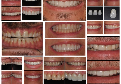 What are Dental Veneers and How Can They Improve Your Smile?