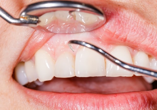 San Antonio, TX Periodontics: How To Prevent Gum Disease Effectively
